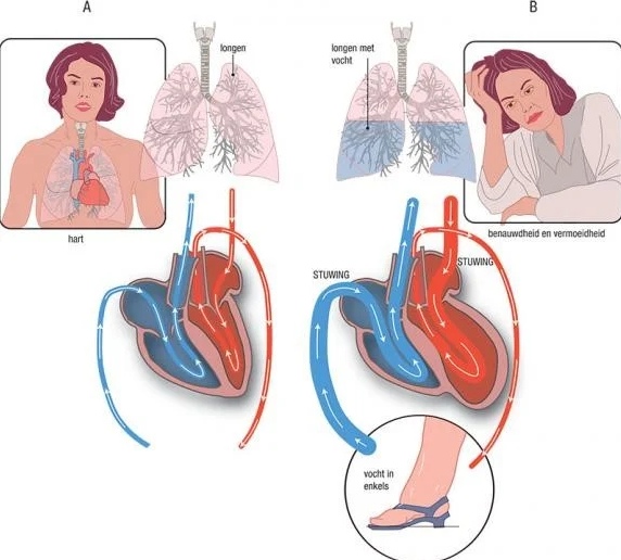 Bij hartfalen pompt het hart minder goed bloed rond. Hierdoor werkt het hart minder goed. Het lichaam krijgt onvoldoende zuurstofrijk bloed. Het bloed of vocht kan zich dan gaan ophopen in de longen en de weefsels.