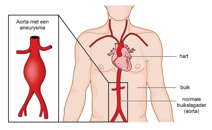 aorta-aneurysma