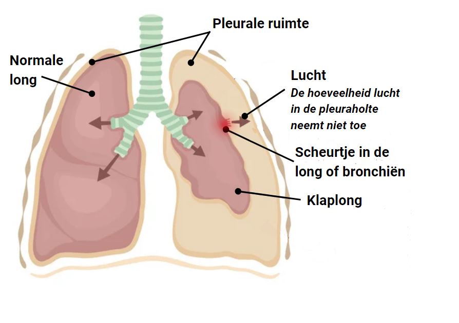 pneumothorax klaplong gaatje in long