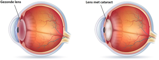 Myopie cataract