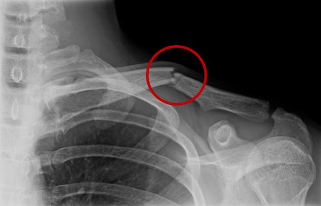 broken-collarbone-shoulder